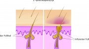 Follikulitis