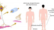 Guillain-Barré-Syndrom