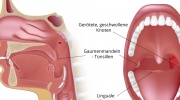 Herpangina