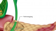 Entzündung der Bauchspeicheldrüse