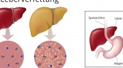 Lebervergrößerung