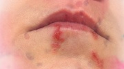 Schmerzhafter Mund - sind es Aphten, Einriss der Mundwinkel oder Herpesbläschen?