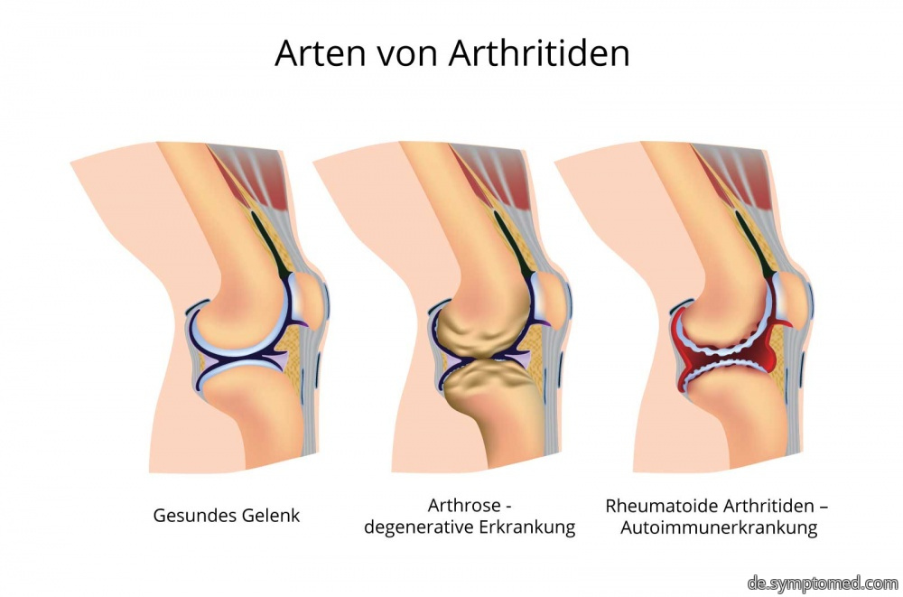 Arten von Arthritiden