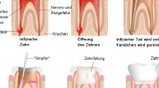 Behandlung des Zahnkanälchens