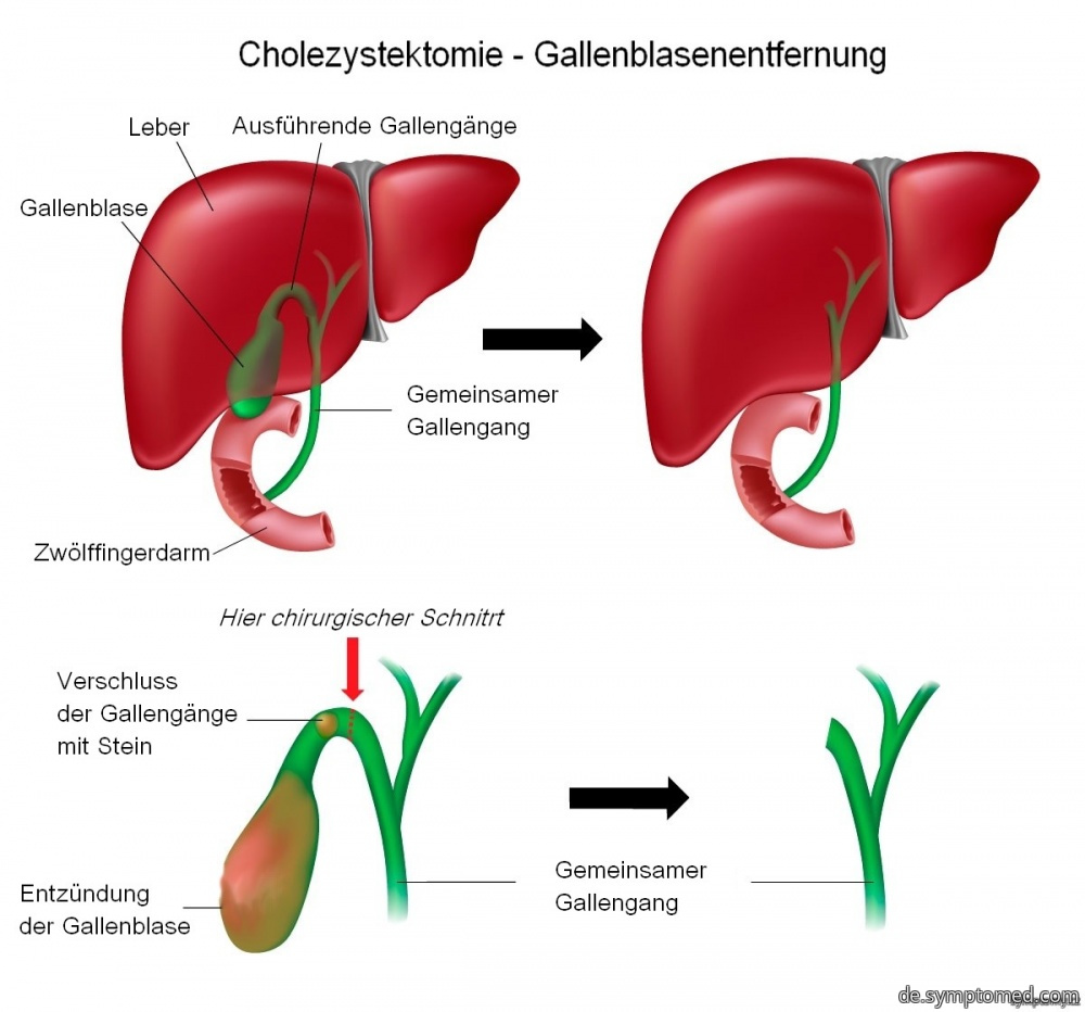 Cholezystektomie - Gallenblasenentfernung