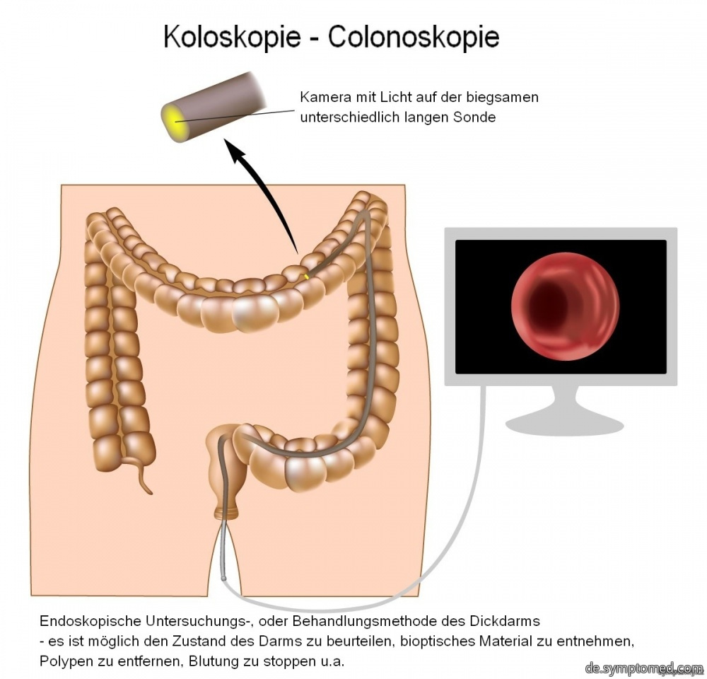 Koloskopie - Colonoskopie