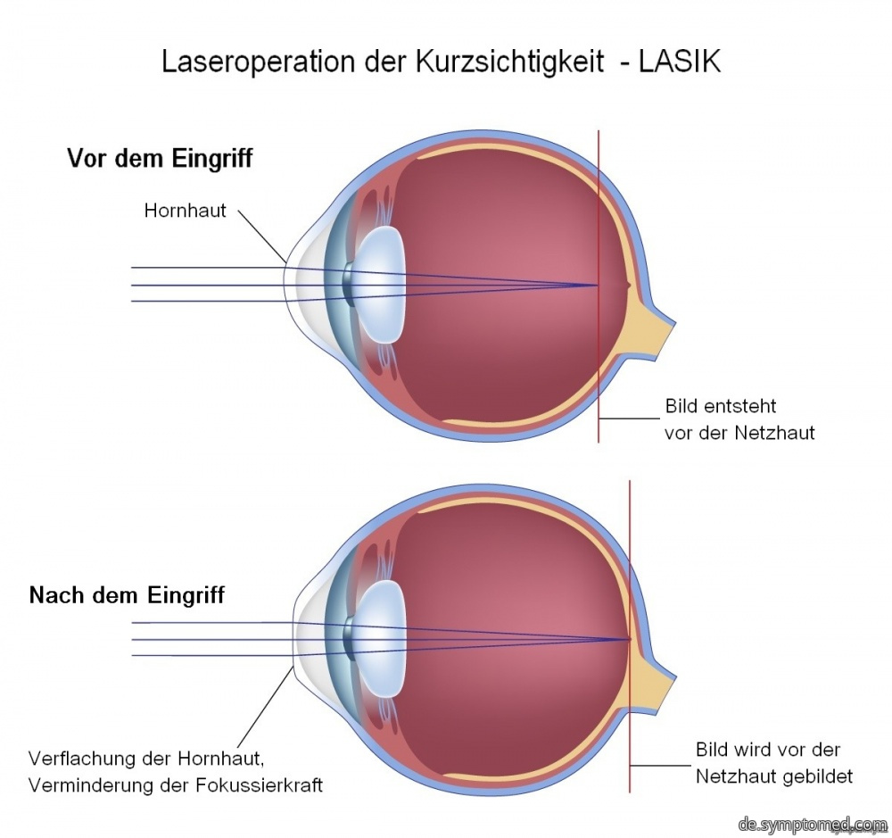 Laseroperation der Kurzsichtigkeit - LASIK