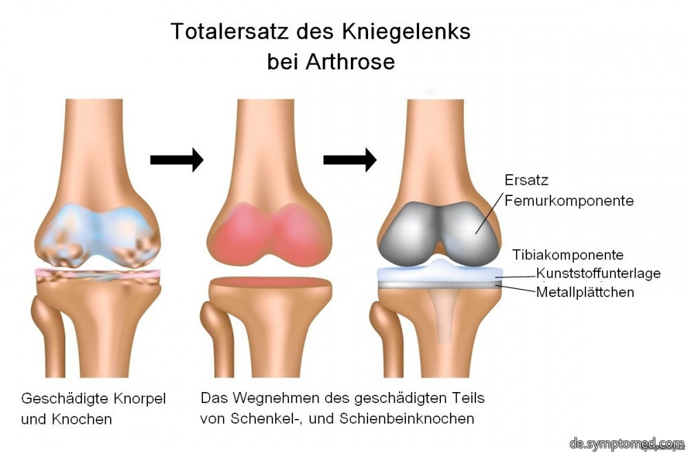 Totalersatz des Kniegelenks bei Arthrose