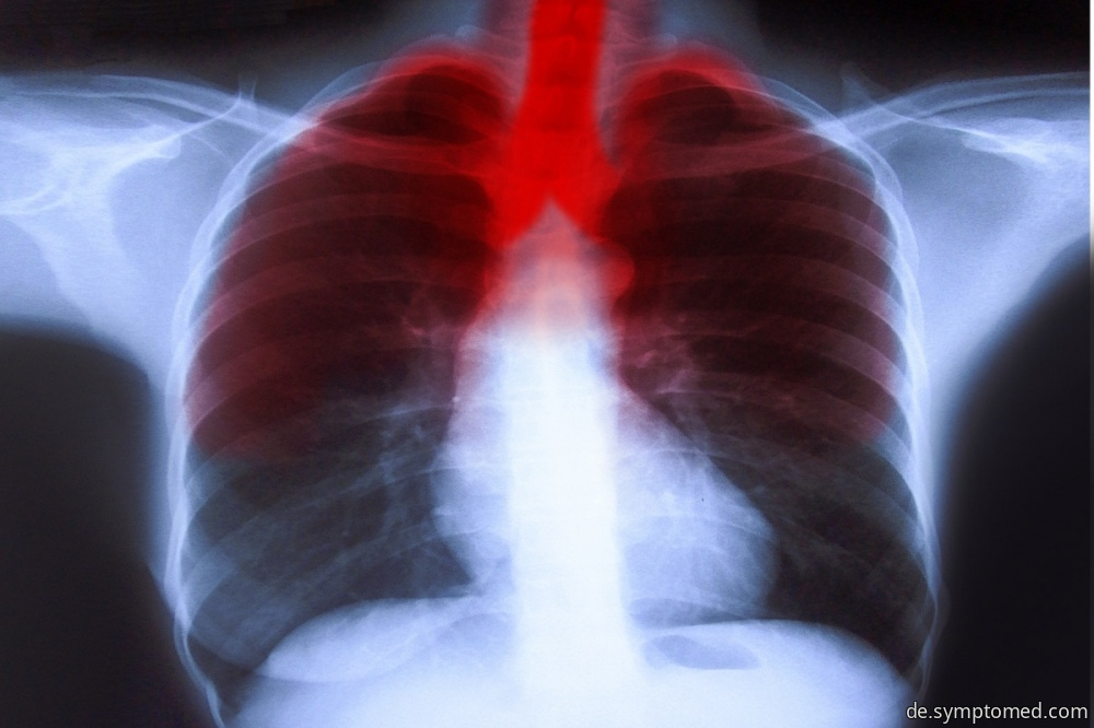 Röntgenbild der Lungenentzündung